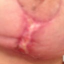 Left healing slow but healing