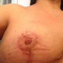 Right still blood drip each day but better seems after it burns it drips releasing the burn pressure I think