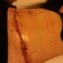 Home from surgery