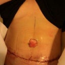 Home from surgery