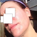 One month later. Outside. No makeup. I do have a moisturizer with sunscreen.