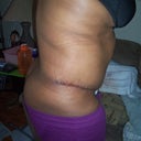 Day 1 Post-Op side view