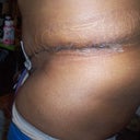 Day 4 Post-Op incision