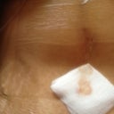 You can still see my old stretch marks.  I plan to tattoo my whole belly once im able too since i hate them . Sucks that doctor couldnt pull any more skin :(
