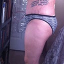 Right - three days post op