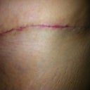 left side of my scar before I started to use ScarAway