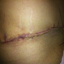 right side of my scar before I started to use ScarAway