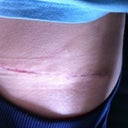 left side of my scar after wearing ScarAway for 12 hours
