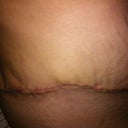 right side of my scar after wearing ScarAway for 12 hours