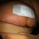 You can see the redness from the infection in this pic.