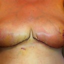 Day 10 post op:
After nipple coverings were removed