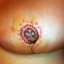 Left nipple 10days post op