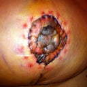 Right nipple 10 days post op