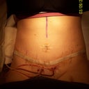 Day 8 Post Op.  Had the last 4 belly button sutures removed and the 2nd of 4 drains pulled.  This one hurt like the dickens but glad to have it out!