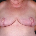Breast Reduction 