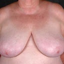 Breast Reduction 