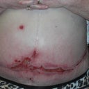 A Hard Swollen Abd. 6 months Post Smart Lipo.  The underwear use to ride at my hips!