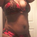 This is the high scar side. PO 10 mos. Pre-revision. We are shooting to get this scar down below this bathing suit and to get rid of the extra fat remaining.