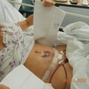 Day 2 post op - not much brusing yet...