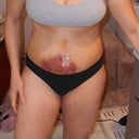 6 days post op. Bruising coming out and it is very sore.