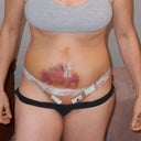 6 days post op