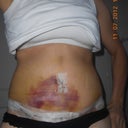 7 days post op. Lots of liposuction over tummy caused this bruising.