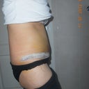 7 days post op, still very swollen, not much waist or hip definition yet.