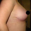 Right breast 9 weeks post-op