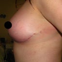 Left breast 9 weeks post-op