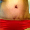 Close up of my scar and bb, still dark, but fading slowly. Using bio oil.