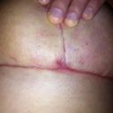t junctions looking better, 28 days post op