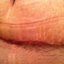 The day the steri- strips were removed. Forgive the pubes.
