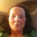 DAY 1 POST OP