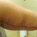 Day 3 bandages removed! I was freaking he said just wait, so I waited! Thrilled though with arms