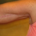 7 months post op the scar continues to fade I dont even think about them anymore