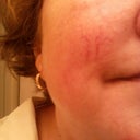 spider vein on face- before