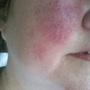 redness on checks right after procedure
