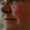 both cheeks had procedure because I had some redness and small spider veins on both cheeks because of my rosacia