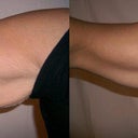 Arms Before & After