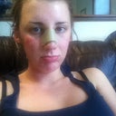 The night that I got surgery.. I bruised pretty quickly and swelled up a little fast, too.