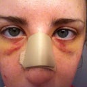 Day 3... UGH THIS WAS THE WORST. I felt so uncomfortable in my own skin, it just felt too tight because I was SO DARN SWOLLEN. I looked like an Avatar and felt terrible.