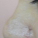 profile after 13 days post op