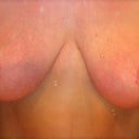 4 months post-op