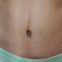 3 months post-op.