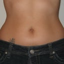 Before the surgery - jeans