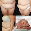 Before photo at ps & what was removed 12 lbs :(