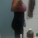 Side vew after bbl and tt 1 week post op