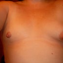 Pre-Op Front View