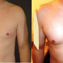 3 months & 3 weeks post op (before and after)