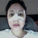 I have barely had any busing but I am still a little yellow around my eyes and my face is quite swollen.